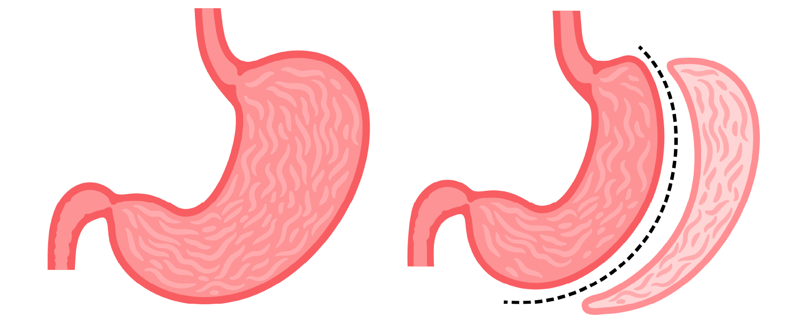 スリーブ胃切除術