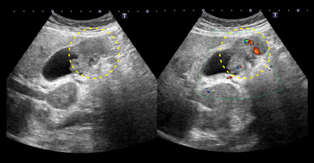 エコー 胆嚢底部を主座とした不整形腫瘤／腫瘤内血流シグナル