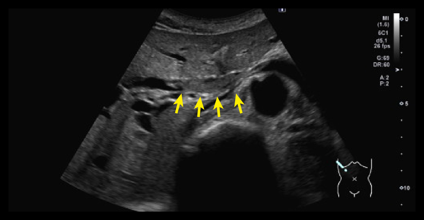 右肝管から総肝管内の腫瘤
