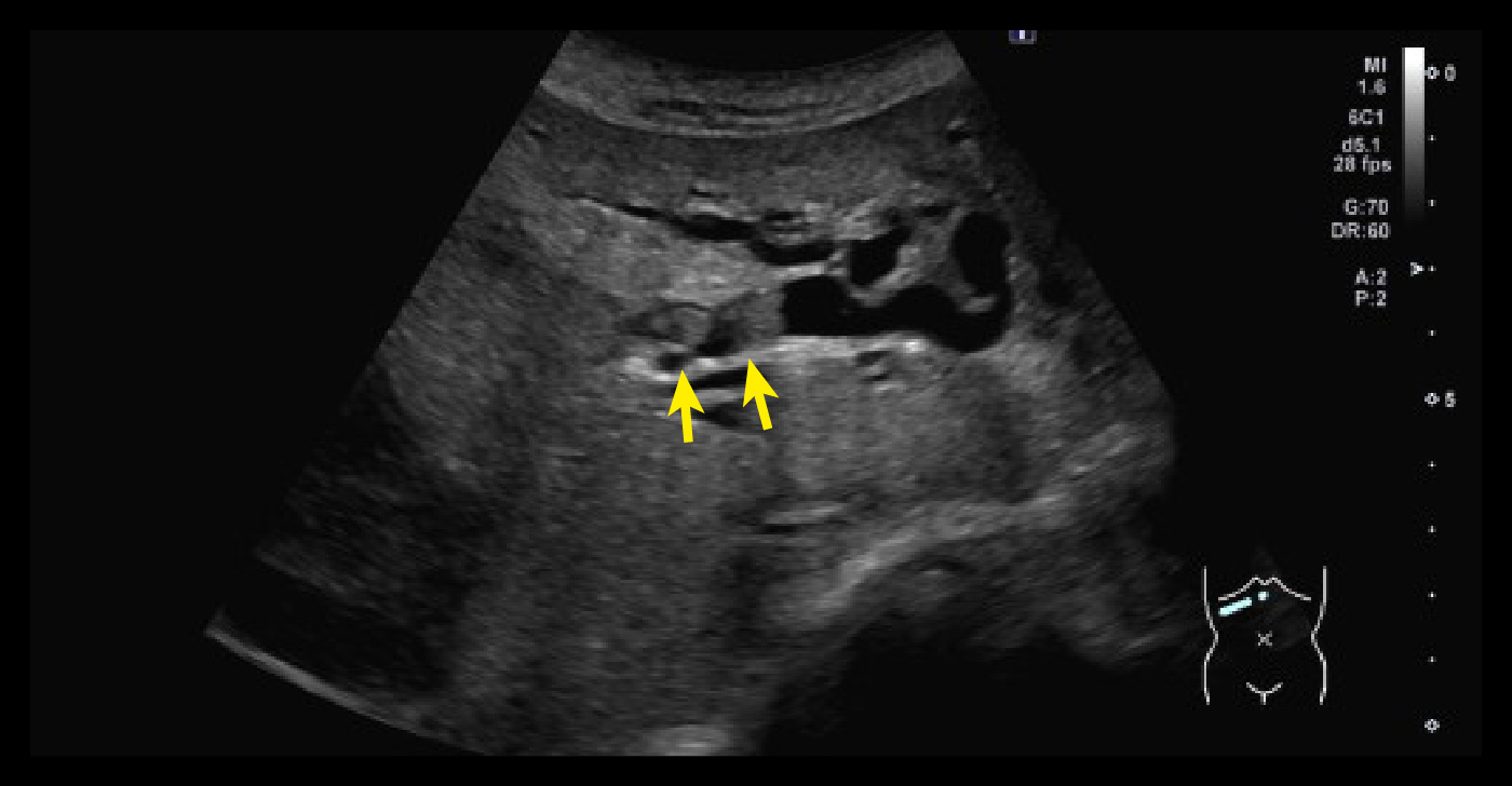 左肝管内の腫瘤