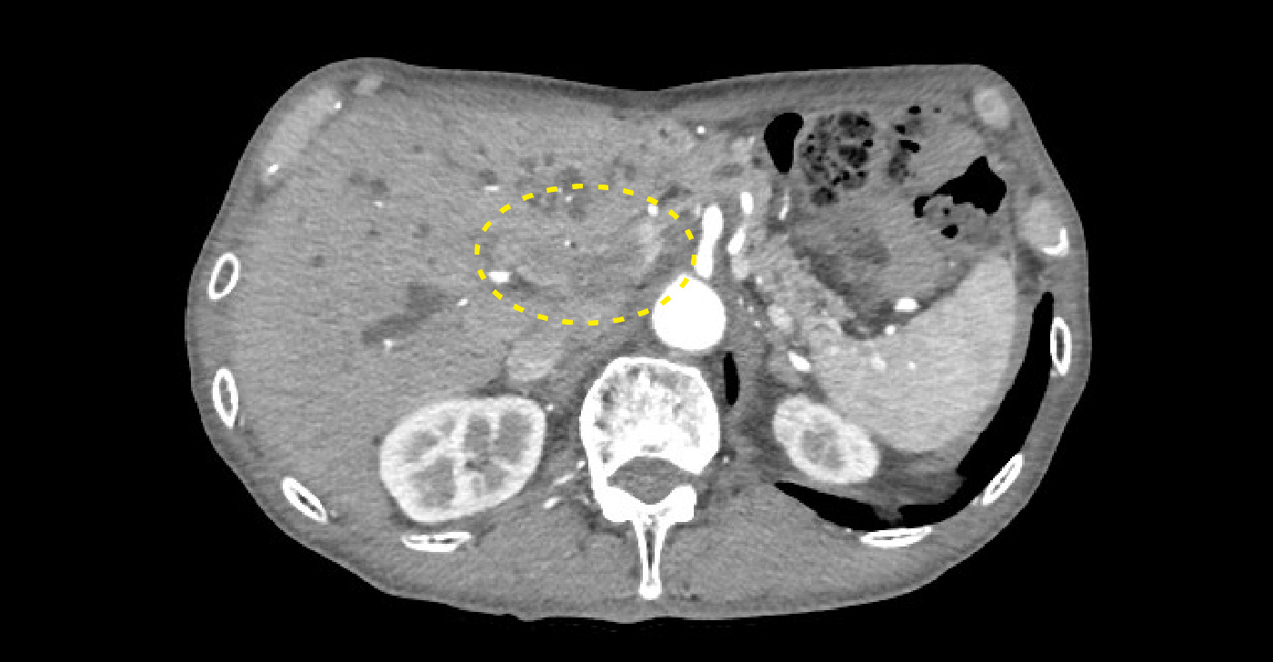 肝門部の境界不整・造影不良領域