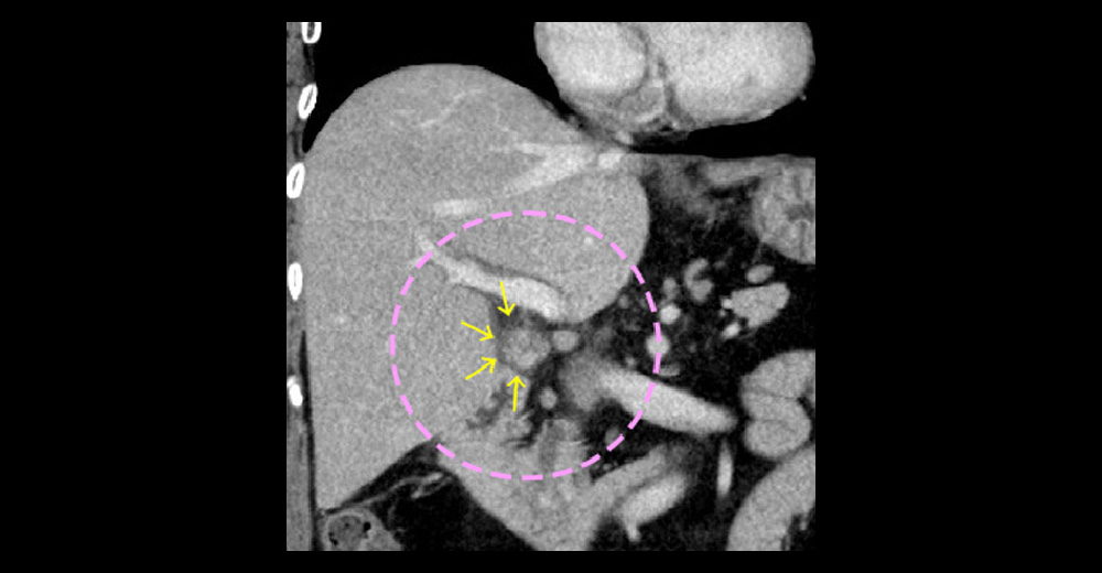 造影CT門脈相＊冠状断