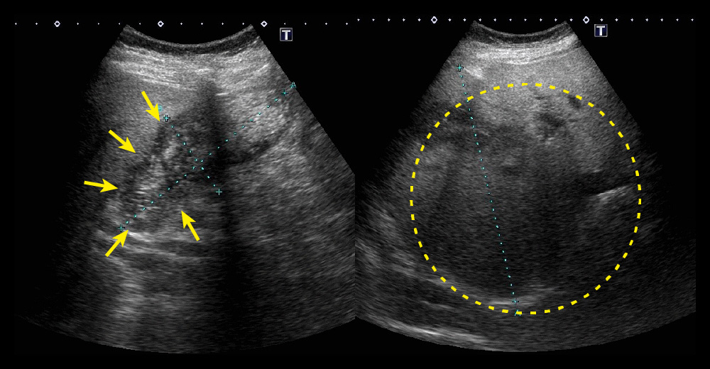 胆のう頸部内不整エコー像／右横隔膜方向 S8ac～S7へ膨隆腫大した胆嚢底部・体部