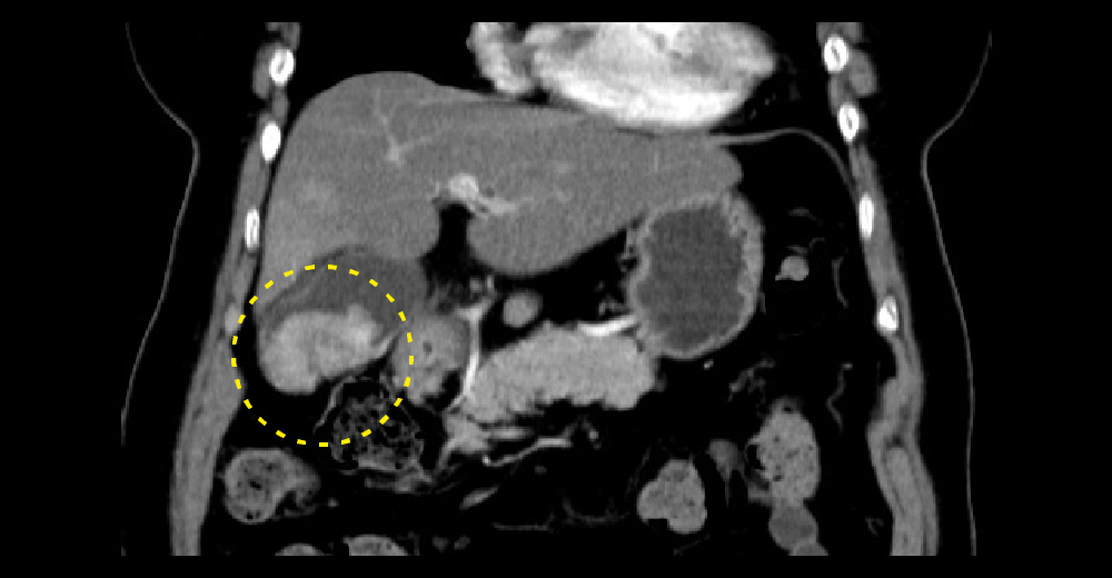 造影CT動脈相／造影CT動脈相＊冠状断