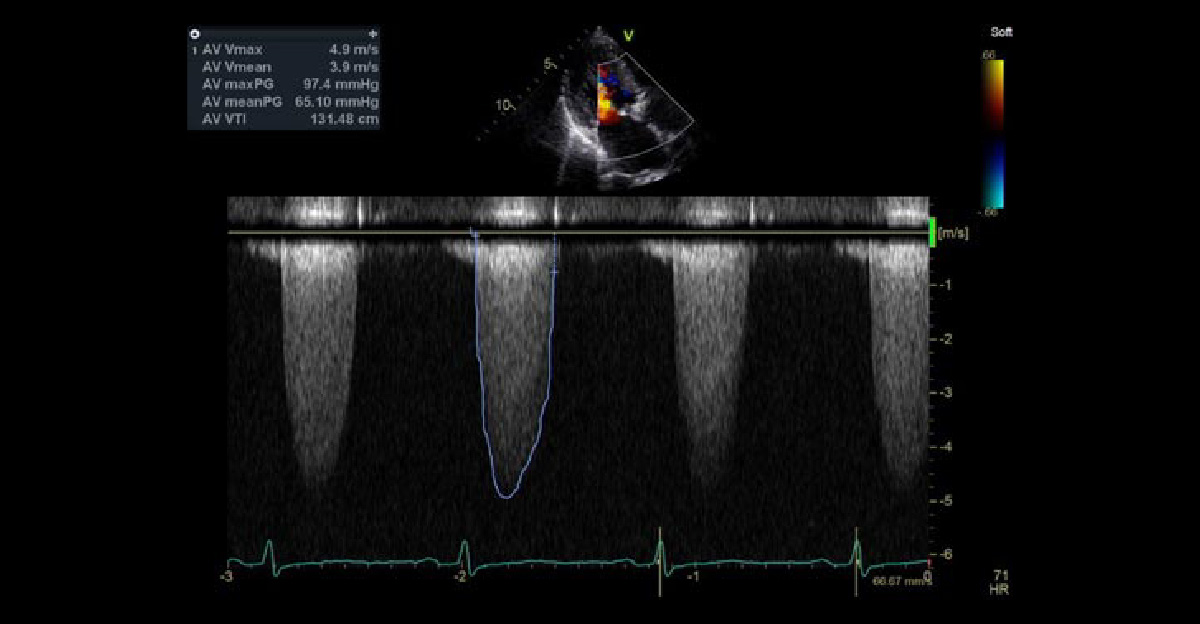 大動脈弁狭窄症