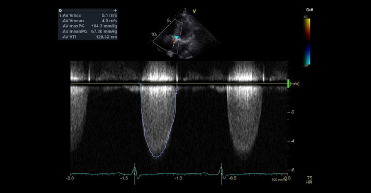大動脈弁狭窄症