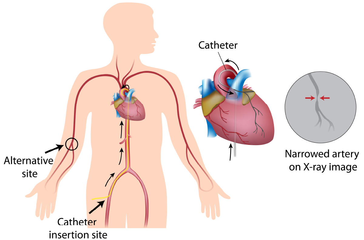 心臓カテーテル