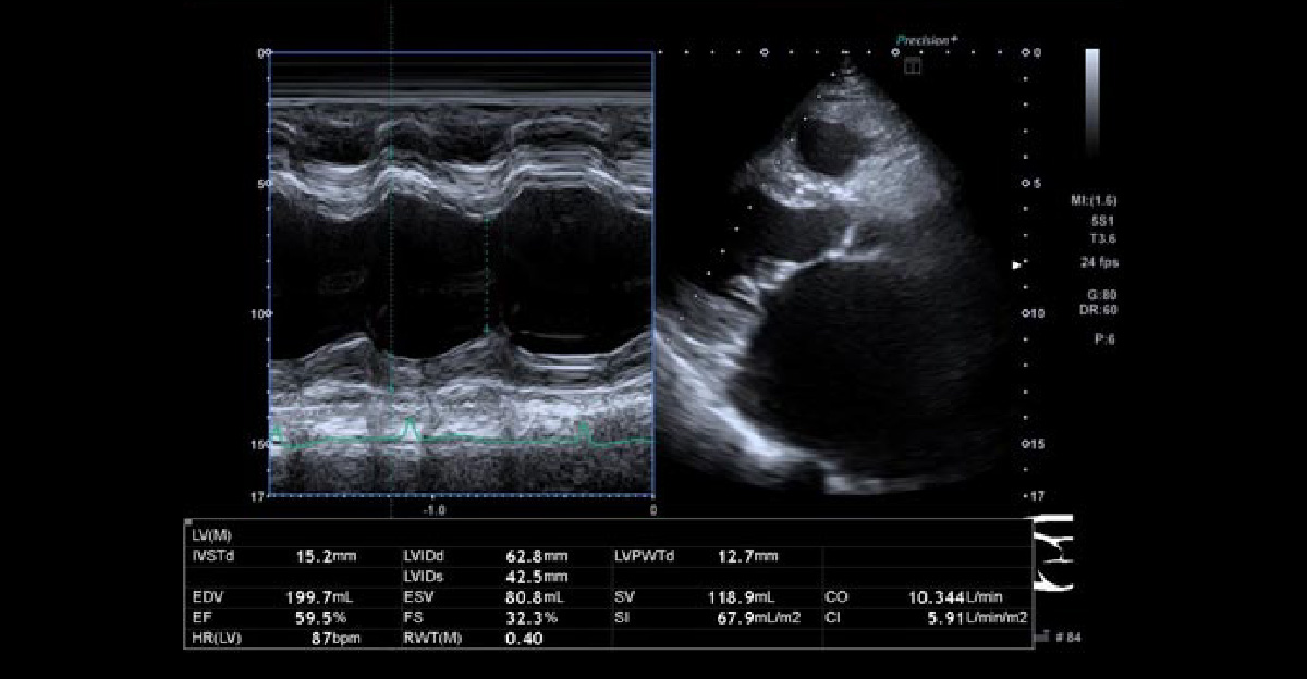 機能的僧帽弁閉鎖不全症