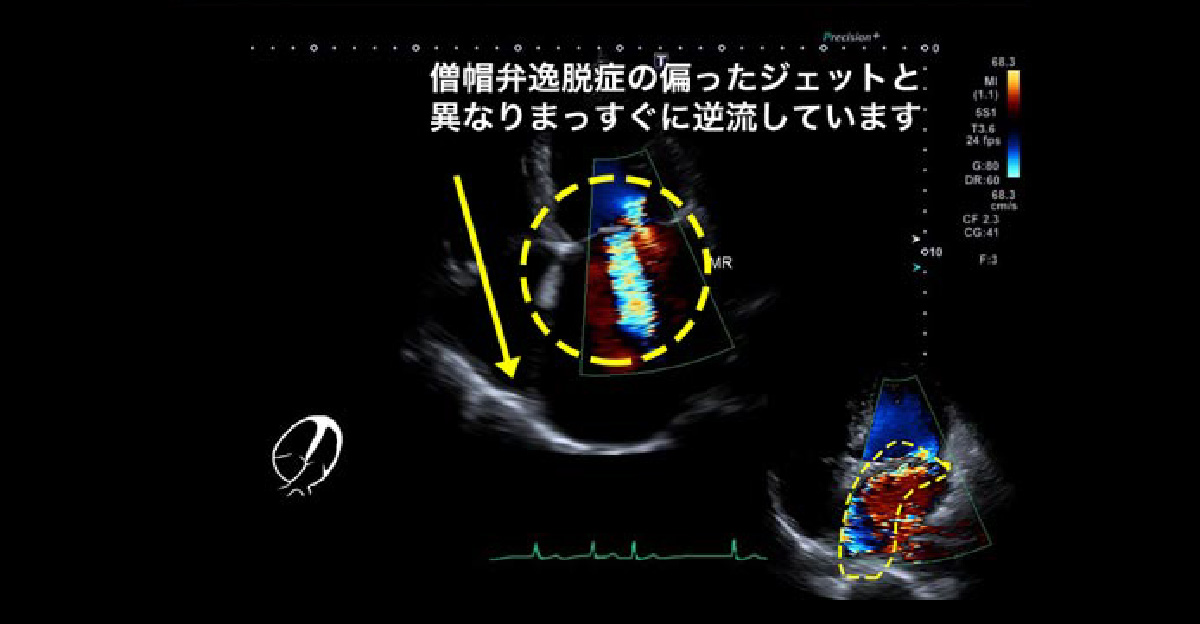 機能的僧帽弁閉鎖不全症