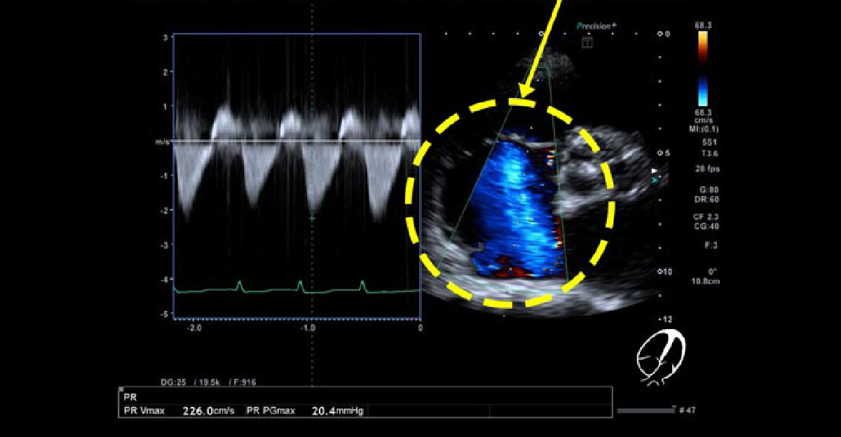 三尖弁閉鎖不全症