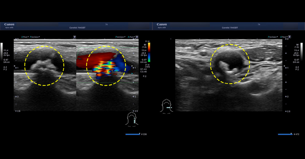 中期 頸動脈エコー 頸動脈狭窄症例