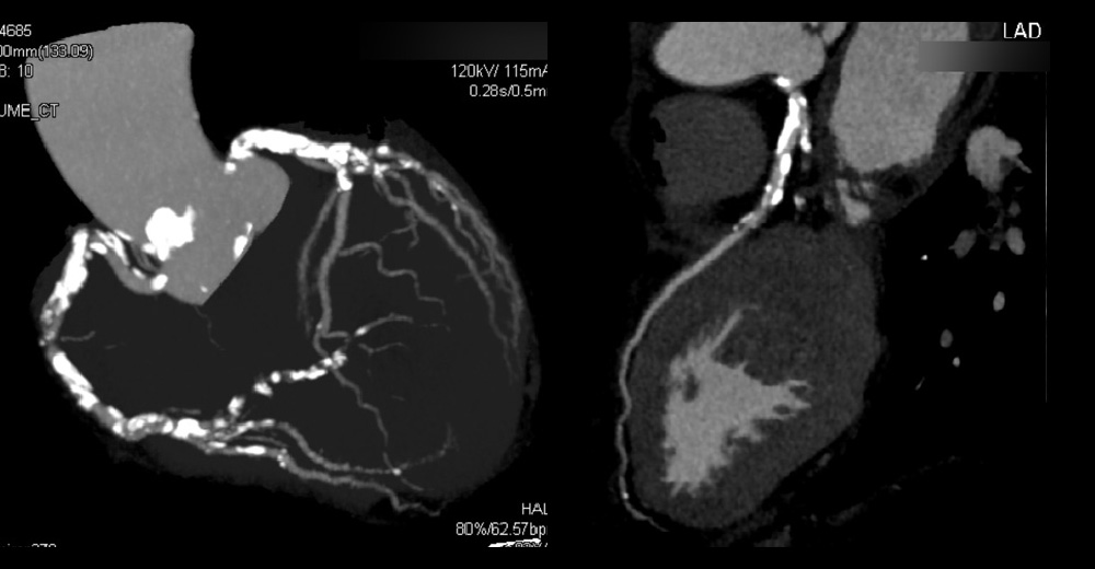 進行期 造影心臓CT 重症心筋虚血症例