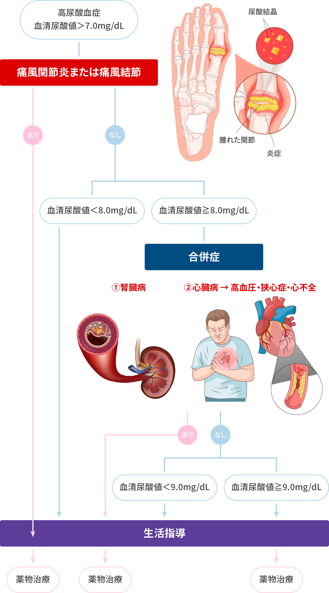 高尿酸血症ガイドライン