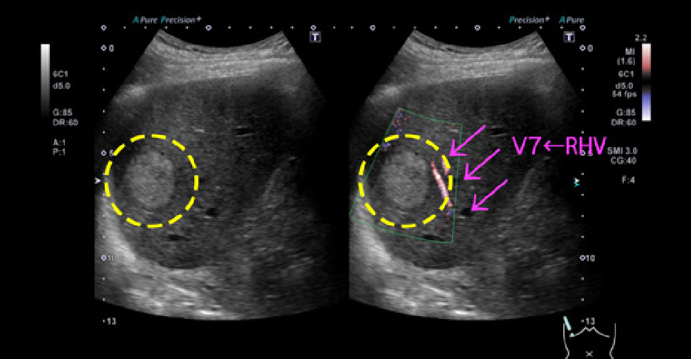 糖尿病併存脂肪肝に、発生した肝がん