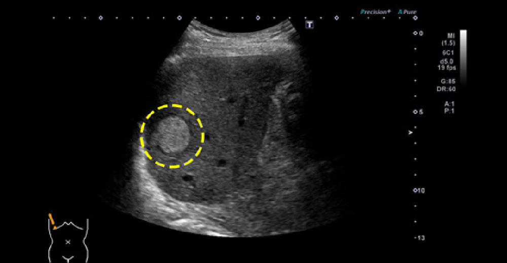 糖尿病併存脂肪肝に、発生した肝がん