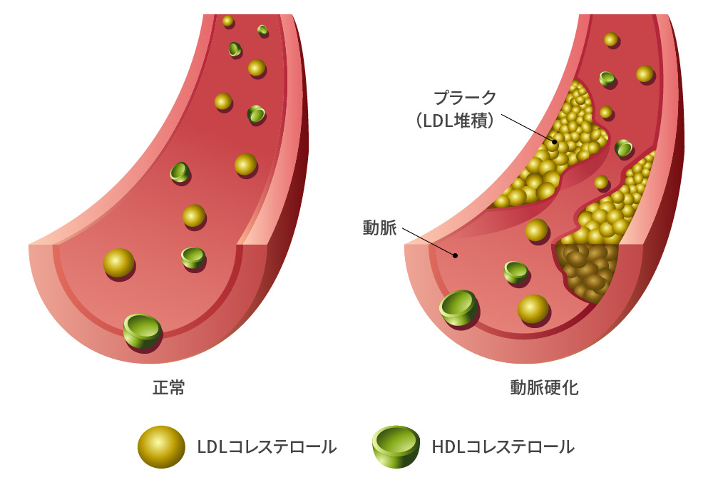 脂質異常症・高尿酸血症