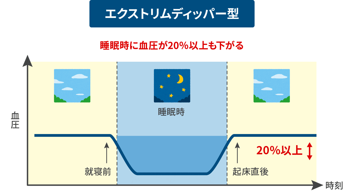 エクストリムディッパー型