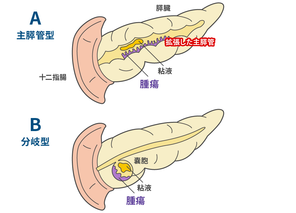 粘液産生膵腫瘍