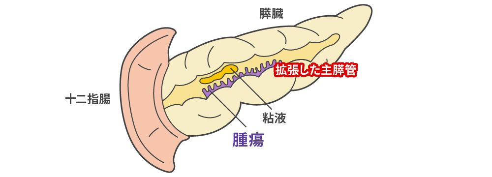 粘液産生膵腫瘍 - 主膵管型