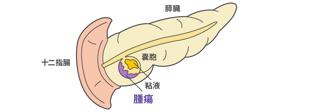 粘液産生膵腫瘍 - 分岐型