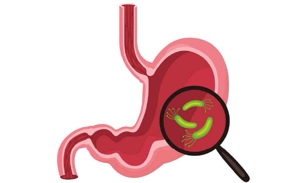 ピロリ菌に関連する疾患