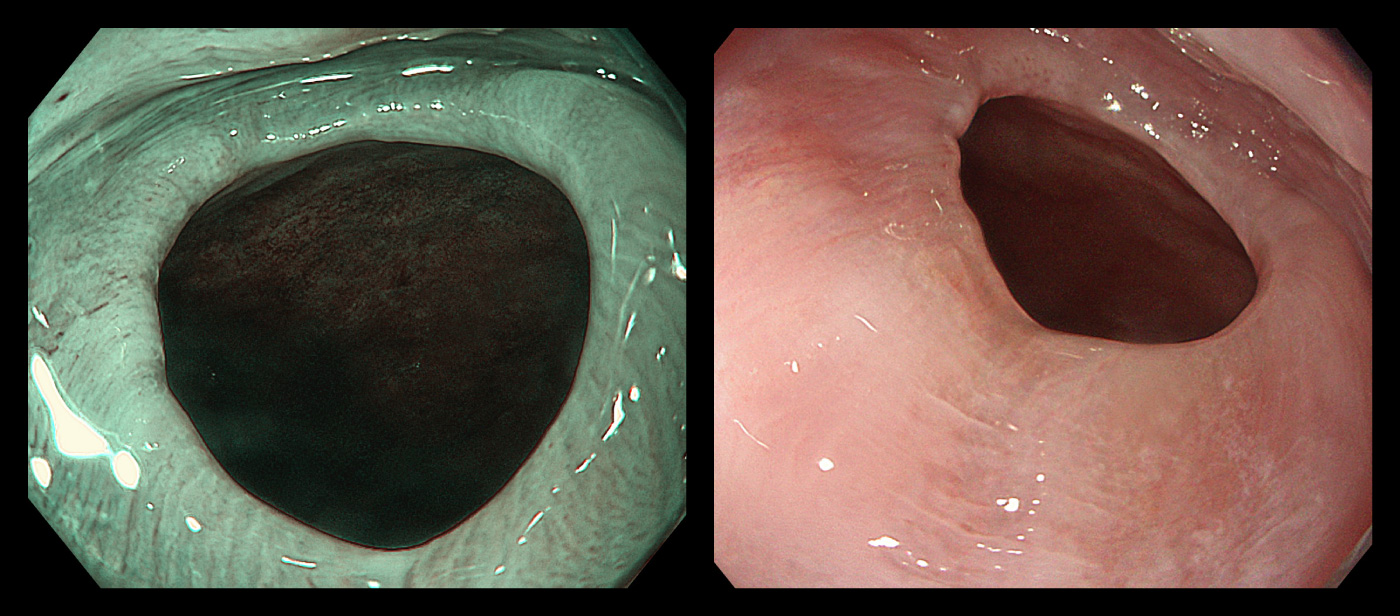 逆流性食道炎に続発した食道狭窄
