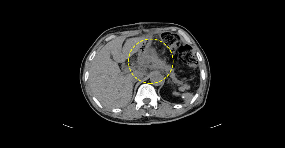 腹腔内膿瘍（のうよう）