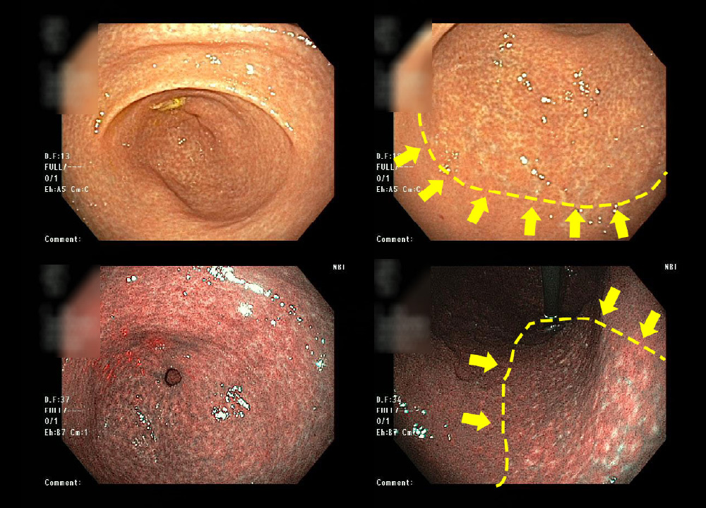 ピロリ菌感染既往
