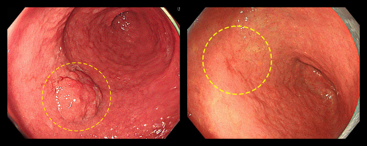 ピロリ菌感染を主因として発生した胃がん