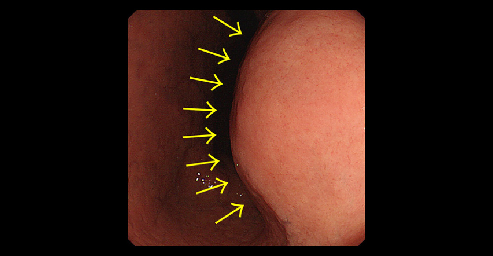 胃GIST～上部消化管内視鏡