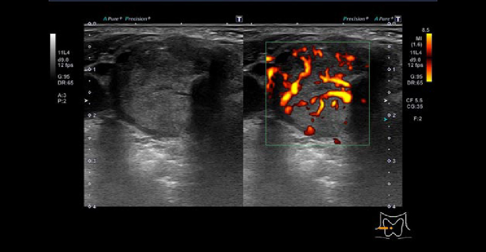 甲状腺乳頭がん