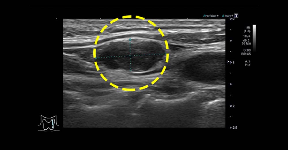 甲状腺がん再発