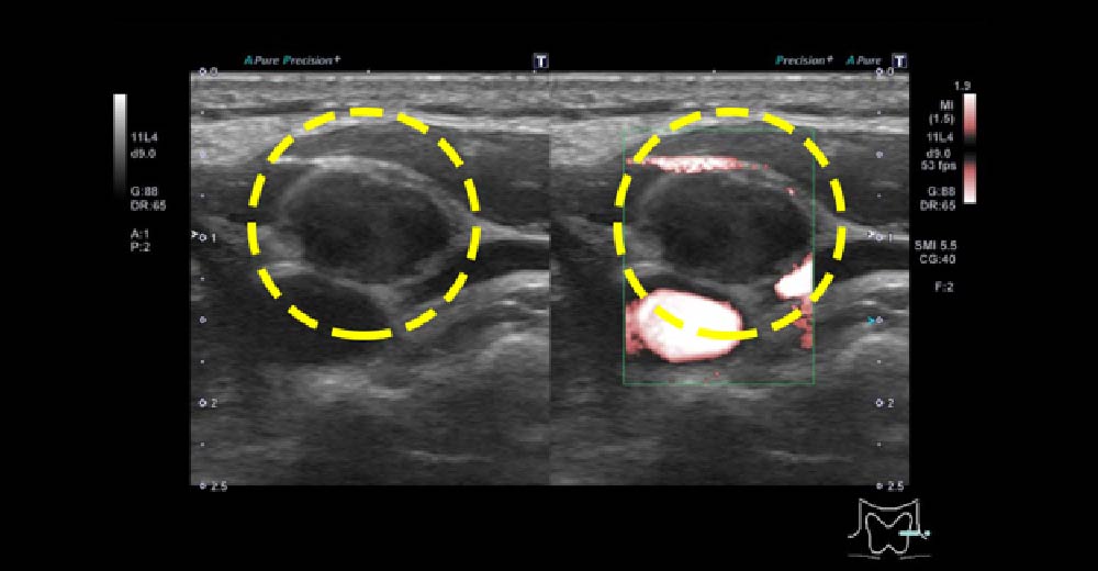 甲状腺がん再発