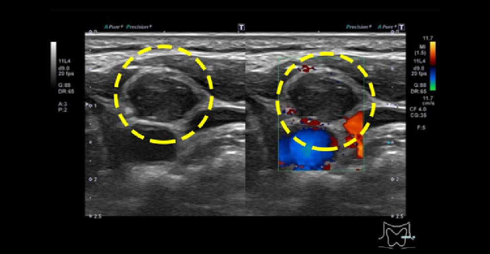 甲状腺がん再発